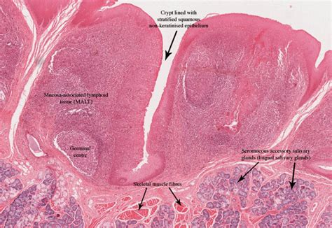 Lingual Tonsils - Tonsillitis and Pictures - (updated in 2022)