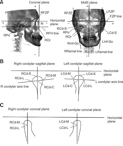 The planes and lines used in this study. A, Horizontal plane, coronal ...