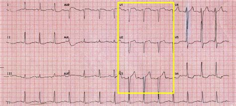 Suspected ST segment elevation myocardial infarction referred for ...