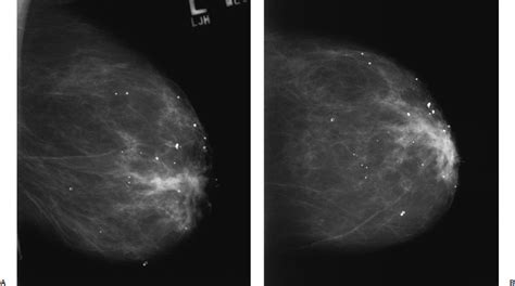 Calcifications: Large Round | Radiology Key