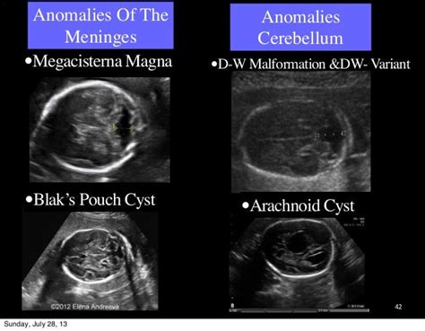 Fetal Neurosonogram