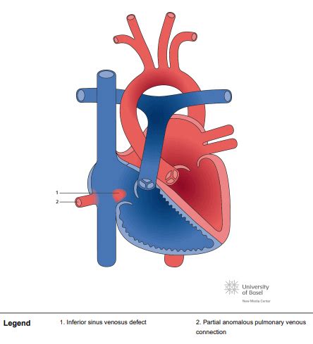 Inferior sinus venosus defect (SVD) with partial anomalous pulmonary venous connection (PAPVC ...