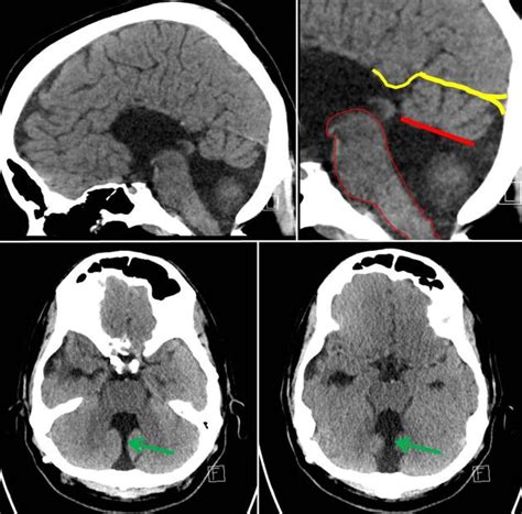 Dandy-Walker malformation | Radiology Reference Article | Radiopaedia ...