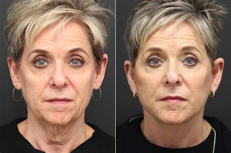 Facelift Photos | Princeton, NJ | Patient 10055