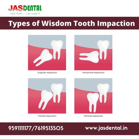 Types of Wisdom Tooth Impaction