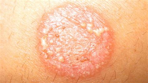 Tinea Corporis (Body Ringworm): Treatment and More