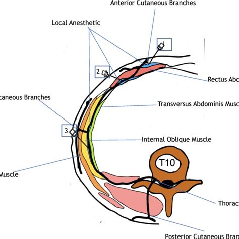 Intraoperative surgical rectus sheath block was performed by injecting ...