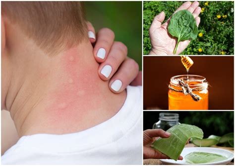 How To Get Rid Of Mosquito Bites: 15 Home Remedies For Instant Relief