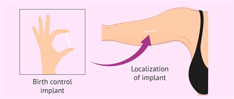 Birth Control Implant: Advantages and Disadvantages