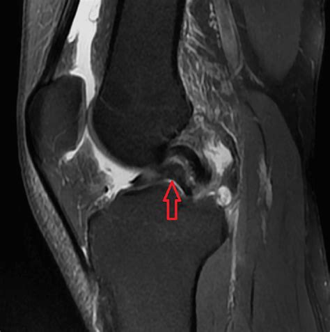 MRI in the Diagnosis of Bucket Handle Tears: What Is the Current Situation? | Cureus