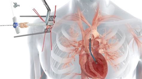 Impella Devices Recalled After Deaths, Injuries Tied to TAVR ...