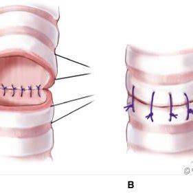 End to end anastomosis | Download Scientific Diagram