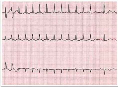 Ablation Complications: Proceed with Caution