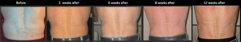 Laser Lipo SA Injections