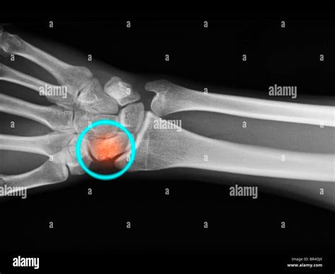 Navicular hand - dkgulf