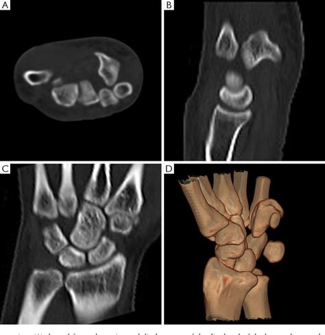 Figure 2 from Isolated complete dislocation of hamate bone with an ...