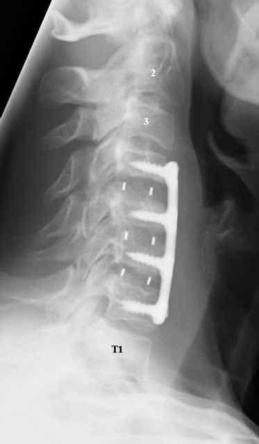 Anterior Cervical Discectomy and Fusion (ACDF) - Drwolgin