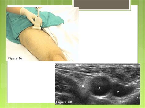 Ultrasound Guided Peripheral Nerve Blocks