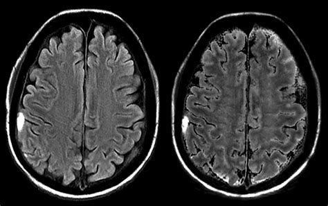 Subdural hematoma on T2 FLAIR in synthetic and conventional 3T MR...