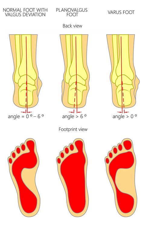 Pronated foot vs supinated foot heel pain - Balance Foot & Ankle ...