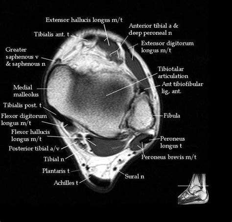 Foot Muscles Mri : Anatomy of the foot and ankle - MRI / A magnetic resonance imaging (mri) was ...