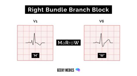 Left Bundle Branch Block Ecg