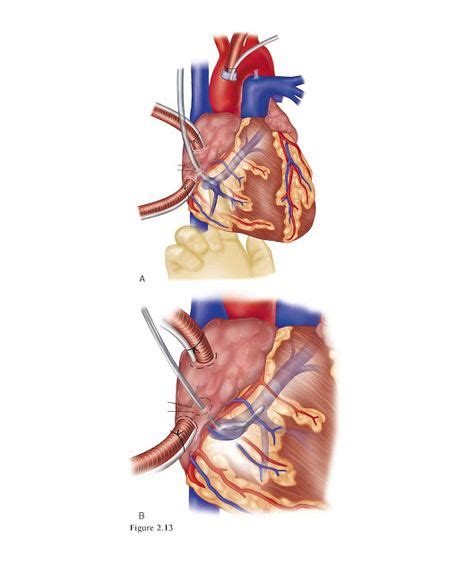 Cardioplegia Cannulation and Venting (Dengan gambar)