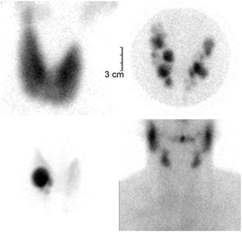 The Role of Nuclear Medicine in the Clinical Management of Benign ...