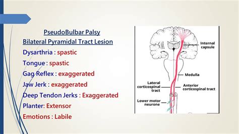 Pseudobulbar Palsy - YouTube