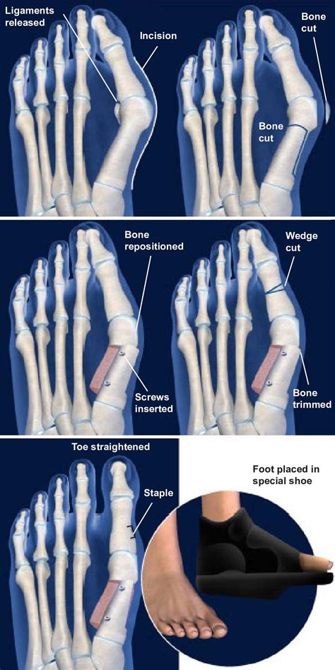 Bunion Correction with Scarf and Akin Osteotomy - Orthoriverside.com