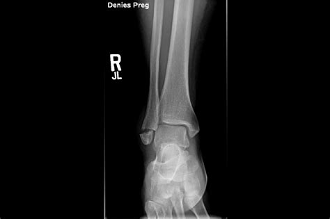 Ortho Dx: Can You Diagnose the Weber Fracture? - Clinical Advisor