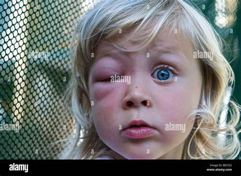 Bee sting face hi-res stock photography and images - Alamy