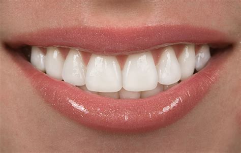 Porcelain Veneers - Cost, Benefits, Risks & Lifespan