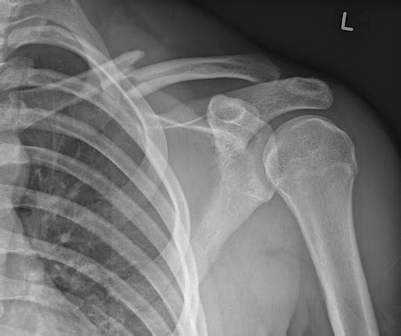Clavicle series | Radiology Reference Article | Radiopaedia.org