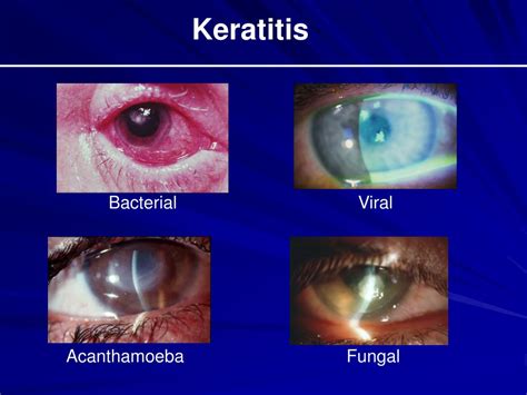 PPT - The Red Eye and Selected Ocular Emergencies PowerPoint Presentation - ID:5640470