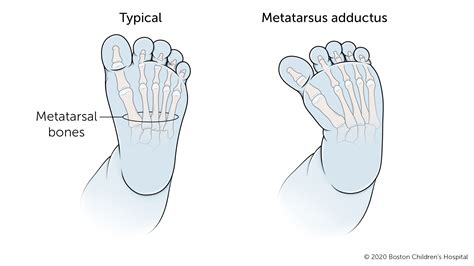 Metatarsus Adductus | Boston Children's Hospital