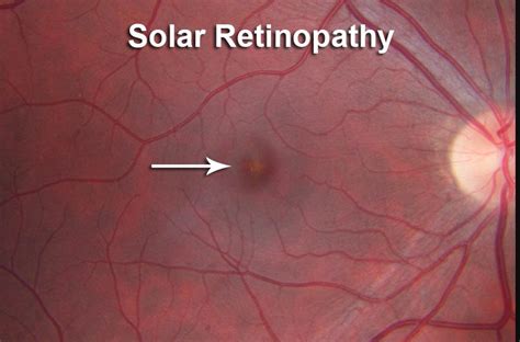 Solar Eclipse Eye Safety - Crandall Eye Physicians and Surgeons