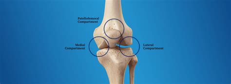 What is Tricompartmental Osteoarthritis? - Here’s What You Need To Know ...