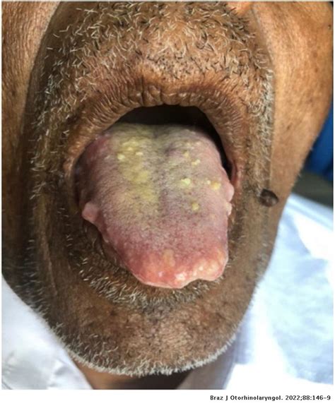 Oral manifestations of systemic amyloidosis, an aid to diagnosis of multiple myeloma – report of ...