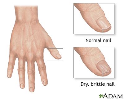 Stripping and Weak Nails: Causes and Tips to Reinforce - newtipny.com