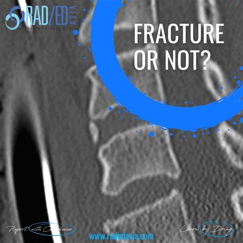 CERVICAL TEARDROP FRACTURE OR NOT TRAUMA RADIOLOGY - Radedasia