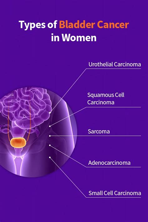 How Many Types Of Bladder Cancer Are There - CancerWalls