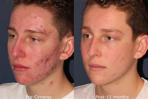 Acne Treatment Dermatology Experts | San Diego, CA | CLDerm