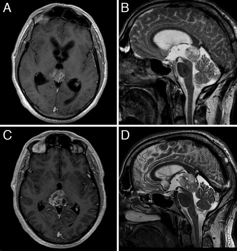 Tectal gliomas: assessment of malignant progression, clinical management, and quality of life in ...