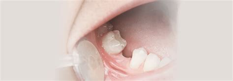 Hypodontia Causes & Treatment For Missing Teeth