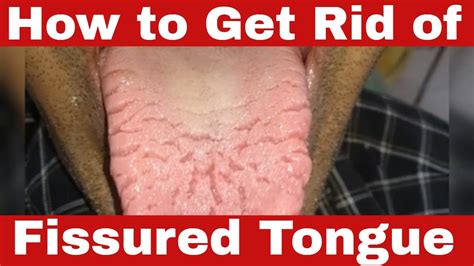 How to Get Rid of Fissured Tongue? The Truth! - YouTube