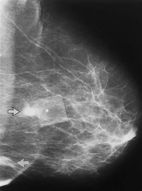 Focal Asymmetric Densities Seen at Mammography: US and Pathologic Correlation | RadioGraphics