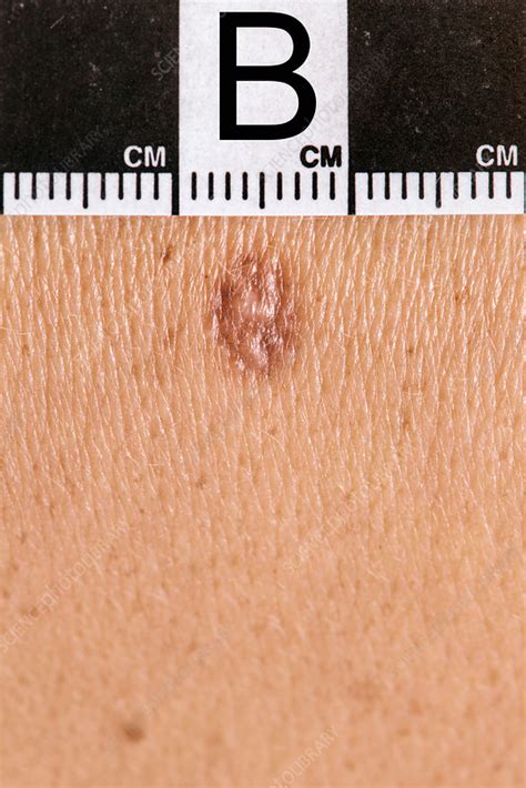 Dermatofibroma diagnosis - Stock Image - C038/2295 - Science Photo Library