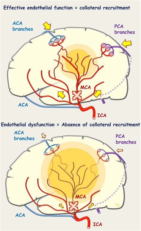 Early Collateral Recruitment After Stroke in Infants and Adults | Stroke