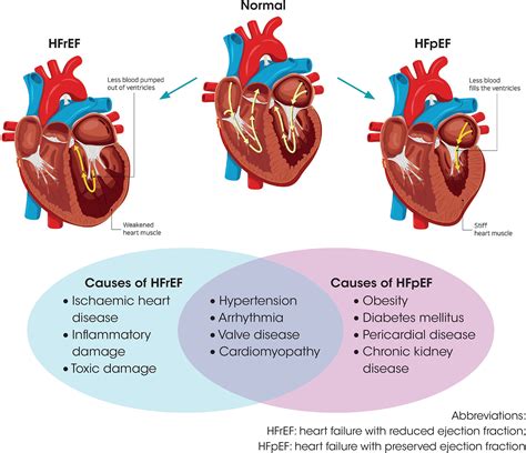 The Pathophysiology Of Hypertensive Acute Heart Failure Heart